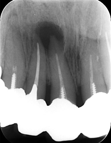 嚢胞歯根端切除